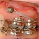 implanty ortodontyczne